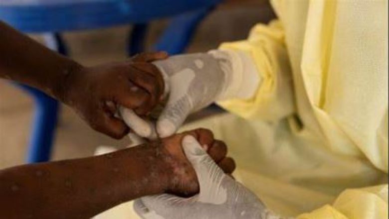 Le Cameroun en alerte maximale contre le Mpox