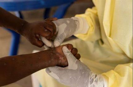 Le Cameroun en alerte maximale contre le Mpox